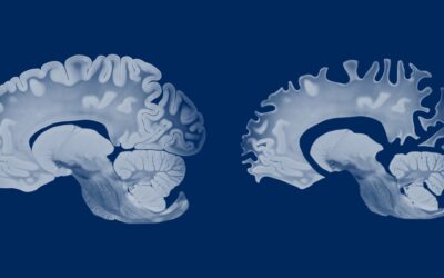 Research Links NAD+ Decline to Alzheimer’s Disease