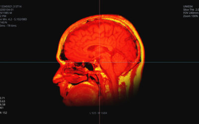 Could NAD Serve as a Biomarker for Stroke Recovery?